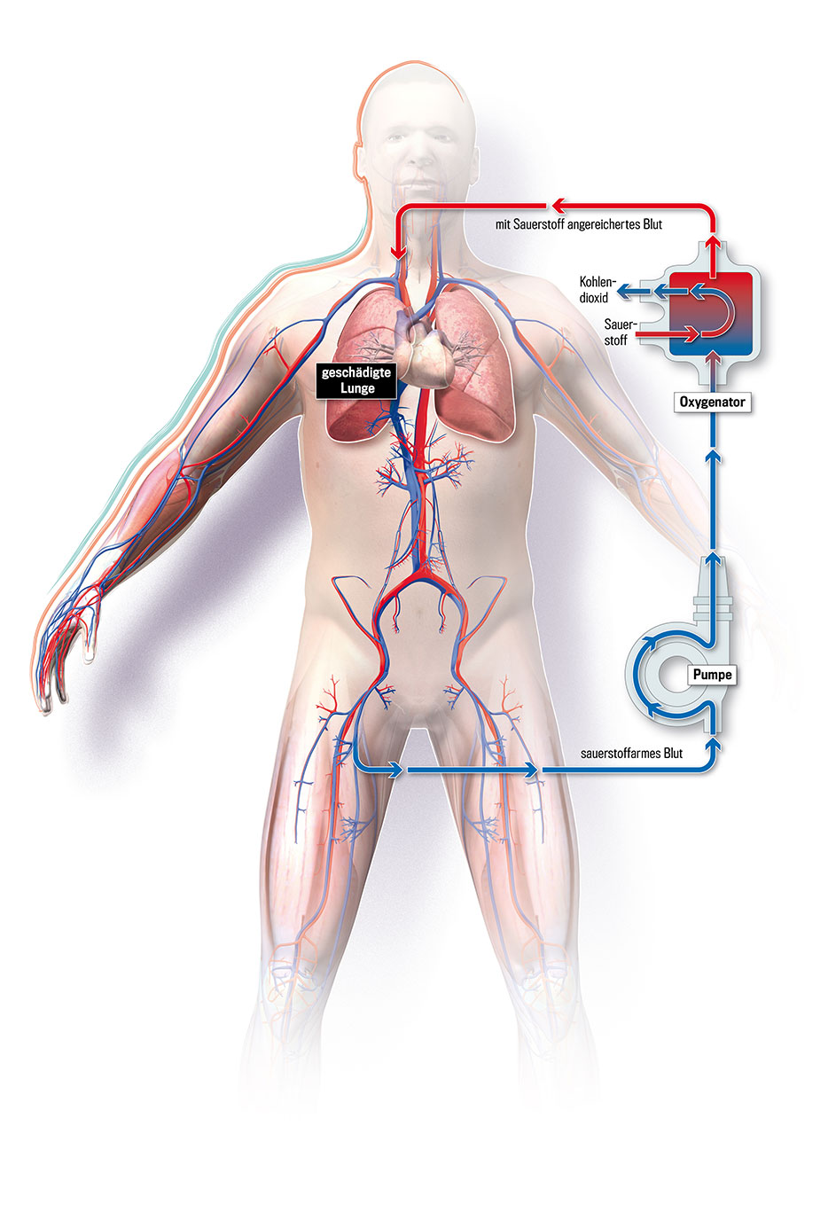 Herz-Lungen-Maschine