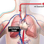 Herz-Lungen-Maschine Medizinillu